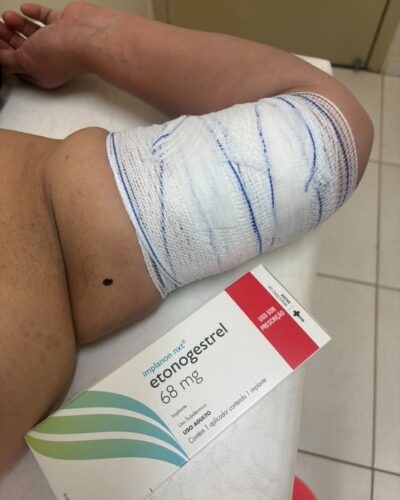 IMPLANON – Método Contraceptivo (evitar gravidez não planejada) de alta eficácia