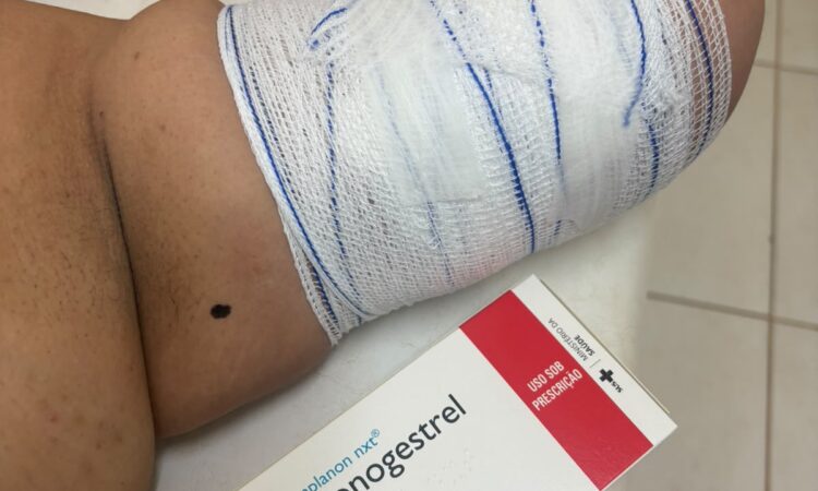 IMPLANON – Método Contraceptivo (evitar gravidez não planejada) de alta eficácia